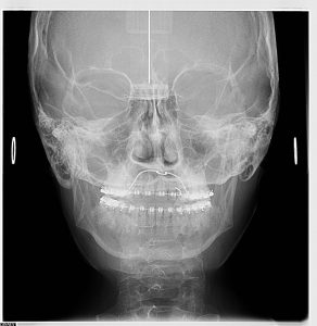 Radiografie antero-posteriora