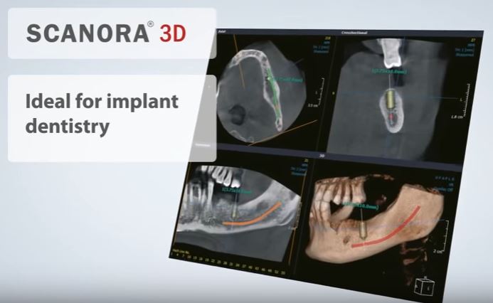 Despre aparatura de imagistica SCANORA® 3D – marca Soredex