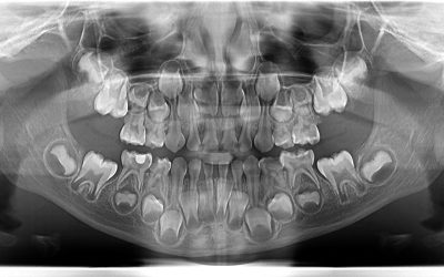 Efectuarea radiografiilor dentare la copii